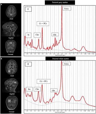 1H-MRS neurometabolite profiles and motor development in school-aged children who are HIV-exposed uninfected: a birth cohort study